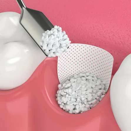 Illustration comparing dental bone augmentation and bone grafting procedures