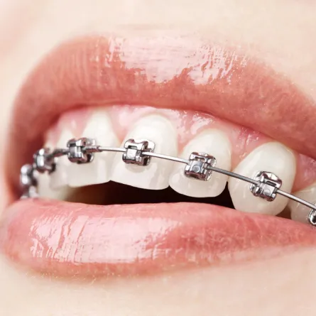 Smiling patient wearing braces, highlighting orthodontic treatment options