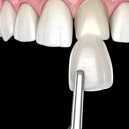 a dental model of a tooth with a tooth veneer