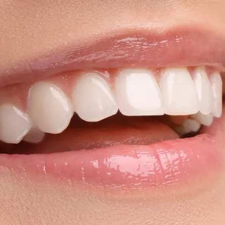a woman's smile with white teeth