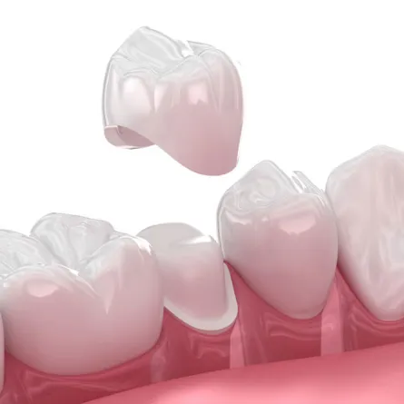 Same-Day Dental Crown - Quick and Efficient Tooth Restoration