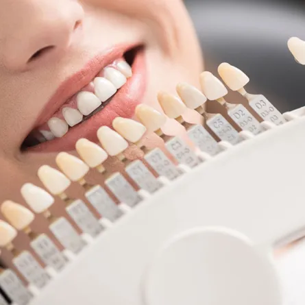 Dental implant model showing a titanium post, abutment, and dental crown for tooth replacement.