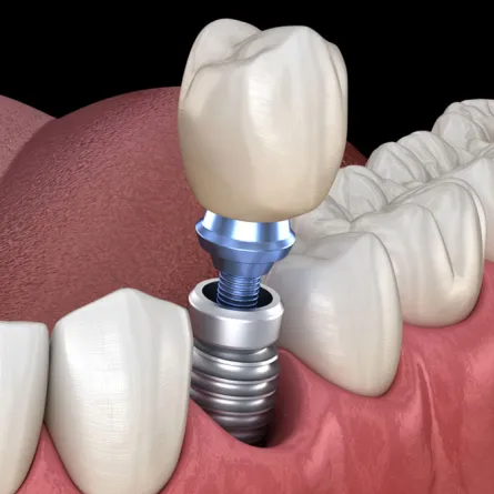 Multiple dental implants with titanium posts and crowns displayed on a dental model, demonstrating full-mouth restoration.