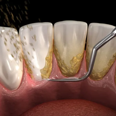a close up of a tooth with Plaque on it