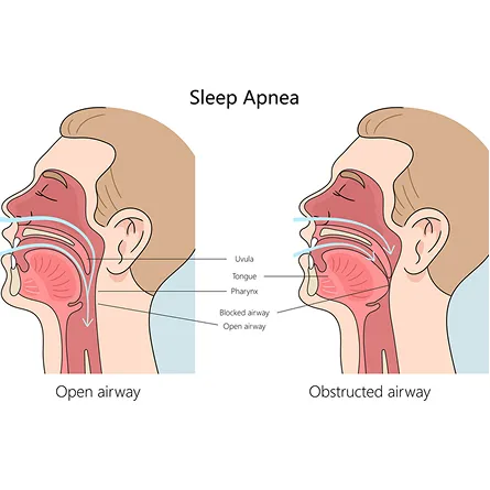 Patient wearing a sleep apnea oral appliance to maintain an open airway during sleep.