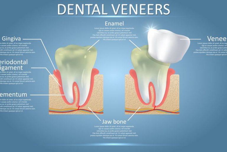 Veneer Teeth Procedure The StepByStep Process Dentist in Jones